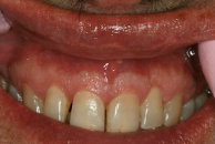 A-Z of Dental Hygiene Part 08 - Dental Biochemistry - Role of Biofilm