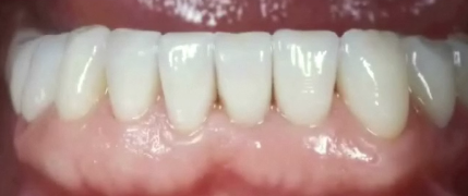 New Advances In Soft Tissue Esthetics Around Teeth and Implants