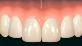 Surgical Microscope for Periodontal Plastic Surgery & Implants (JAPANESE LANGUA