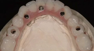Why Guided Surgery (Part 2) - Edentulous Treatment Options