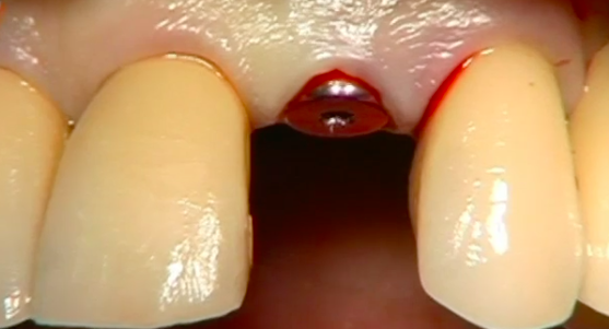 CLINICAL VIDEO Immediate Tooth Replacement Using Forced Orthodontic Extrusion