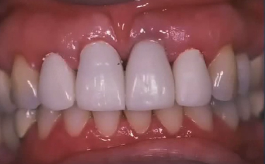 Anterior Implant Restoration: Advanced Concerns