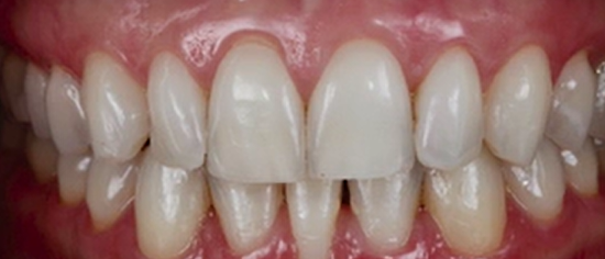 CLINICAL VIDEO Root Coverage – Deep Single Recession | Dr Robert da Silva