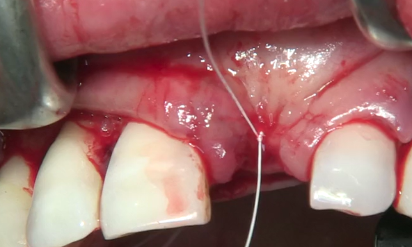 CLINICAL VIDEO Staged Horizontal GBR and Soft Tissue Augmentation  | Jovanovic