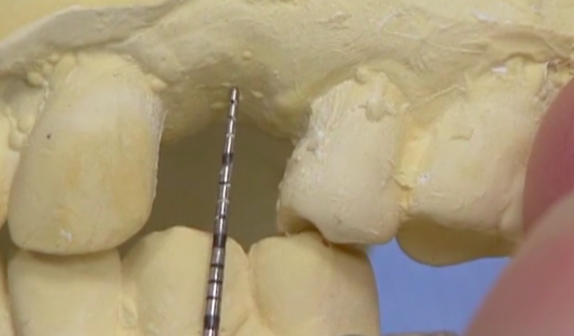 CLINICAL VIDEO Single Implant Placement for Missing Upper Premolar: Patient Cons