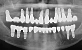 Achieving Ultimate Aesthetics with Implants in the Aesthetic Zone: Lecture III