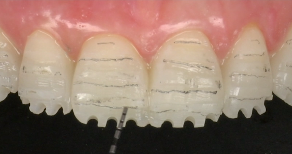 CLINICAL VIDEO Minimally Invasive Approach to Calibrated Veneer Preparation Pt 1