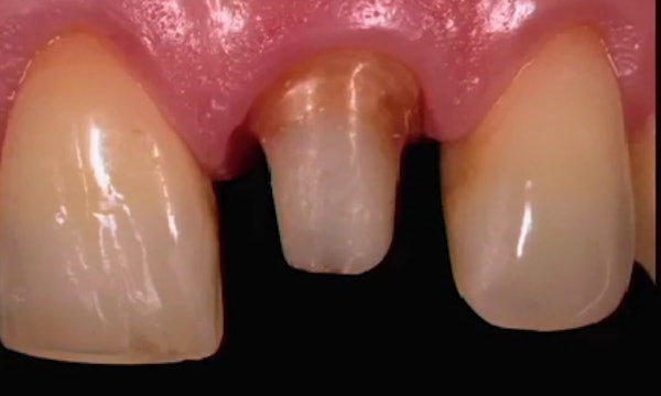 Prosthetic Material Selection for Rehabilitations in the Esthetic Zone