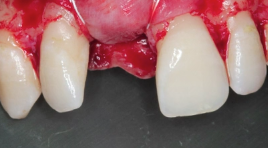 CLINICAL VIDEO GBR Membrane Stabilization using Internal Mattress Sling Suture