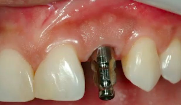 A-Z in Restorative Implant Dentistry ...