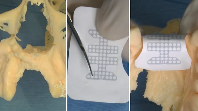 CLINICAL VIDEO Novel approach to trim...