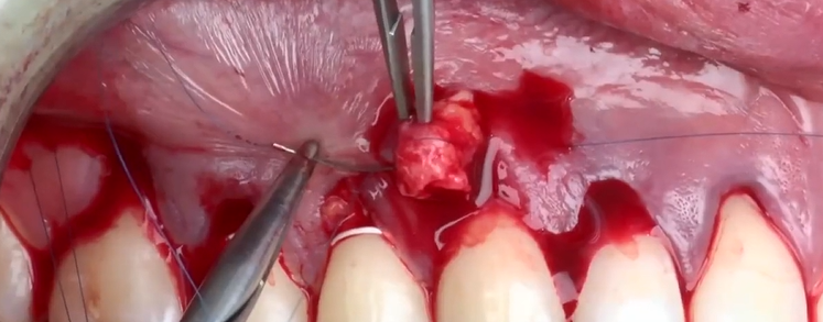 Soft Tissue Management around Natural Teeth & Dental Implants