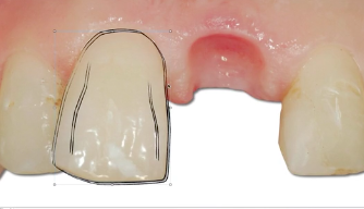 New Advances in the Treatment of the Esthetic Zone - The Esthetic Preview