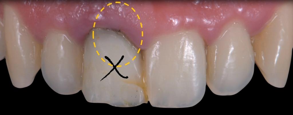 CLINICAL VIDEO Immediate Anterior Extraction Site Implant 