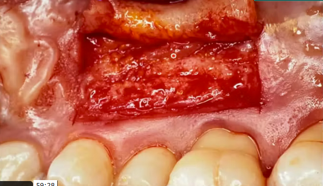 Management of implant complications during healing and before final prosthetic