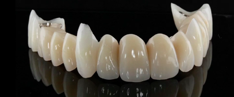 High End Implant Solutions for Patients with an Angle Class II Downhill Dentiti