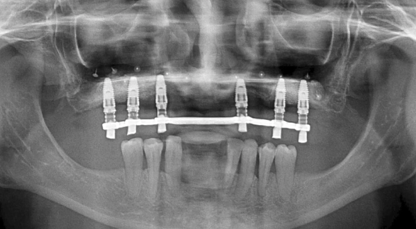 CLINICAL VIDEO Two Stage Full Maxilla Reconstruction with Collagen Membranes and