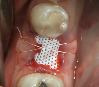 CLINICAL VIDEO - Socket Preservation after a Lower Molar Extraction | JOVANOVIC