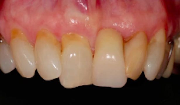 Peri_implant soft tissue management |...