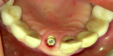 The Role of Prosthodontics in Preservation of Soft-Hard Tissue|Dr S. Pelekanos