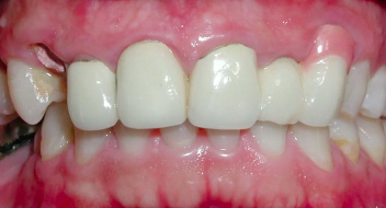 Predictable Soft Tissue Grafting for Esthetics in Thin Periodontium