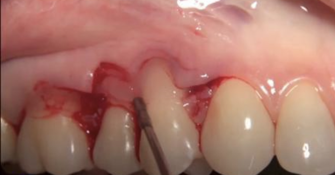 CLINICAL VIDEO - Single tooth gingival recession treatment using a connective ti
