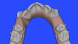 Ortodonzia estetica per il dentista generico col sistema invisalign (ITALIAN LA