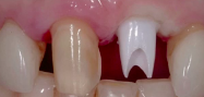 Restoration of 'Failing' Single Teeth with Implants in the Aesthetic Zone - The