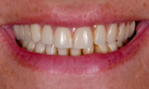 Full Mouth Rehabilitation – Esthetic ...