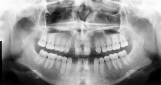 Horizontal Bone augmentation using bo...