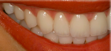 Esthetic and Functional Dentistry: Conservative Smile Enhancement