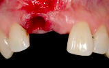Peri-implant soft tissue management