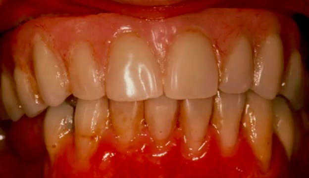 A-Z in Restorative Implant Dentistry ...