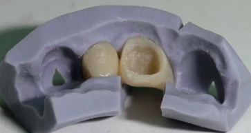 Immediate Implant Provisionals in the Aesthetic Zone | Dr Todd Schoenbaum