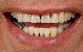 Integrated Rehabilitation Using Adjacent Implants in the Esthetic Region