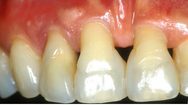 Extraction site bone grafts and immediate vs. delayed implant placement