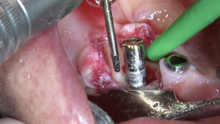 CLINICAL VIDEO Surgical treatment of Periimplantitis with Implantoplasty