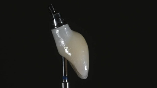 CLINICAL VIDEO Guided Immediate Implant with Immediate Definitive Crown