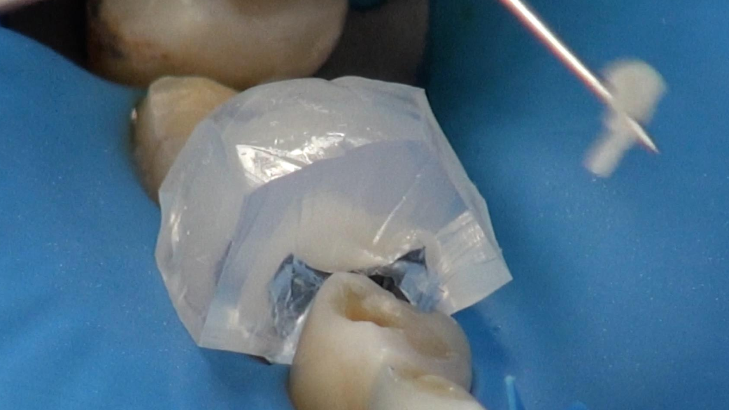 CLINICAL VIDEO Index Adhesive Technique - Part 02