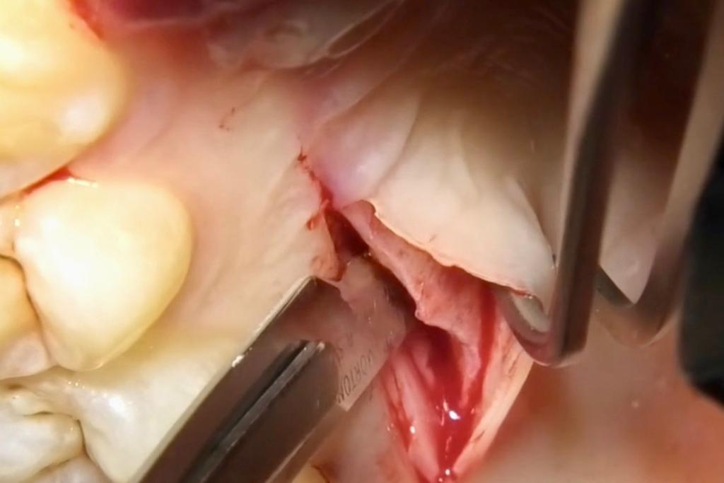 CLINICAL VIDEO Palatal Connective Tissue Harvest