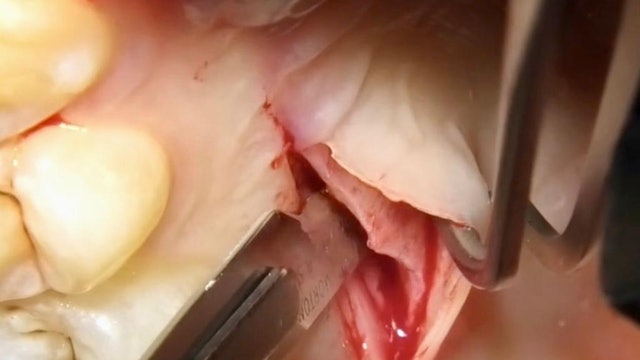 CLINICAL VIDEO Palatal Connective Tissue Harvest