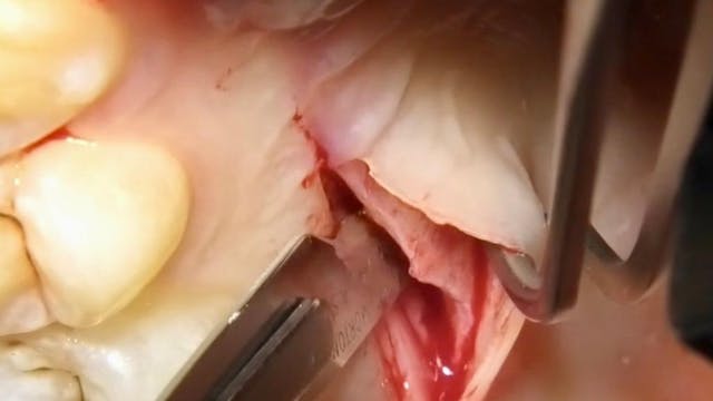CLINICAL VIDEO Palatal Connective Tis...