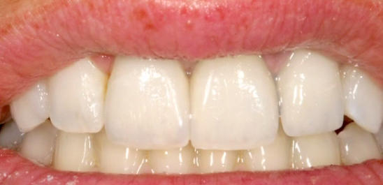 CLINICAL VIDEO Immediate tooth replacement of right upper central incisor with t