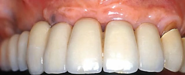 Sinus augmentation using the lateral ...