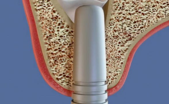 State of the Art in Sinus Augmentatio...