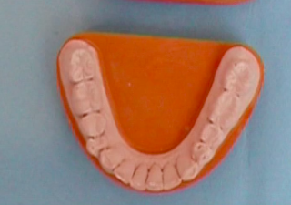 CLINICAL VIDEO NobelActive Dental Implant: Extraction/Immediate Temporization