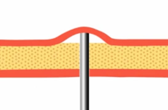 Optimalization of Sinus Augmentation ...