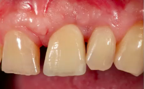 Principles of Guided Bone Regeneration: Horizontal Ridge Augmentation Utilizing
