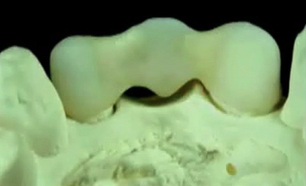 Perio-prosthetic Considerations Around Natural Teeth | Dr Eric van Dooren