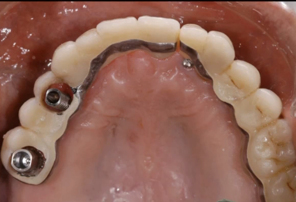 Staged temporization of multiple dental implants in a partially edentulous patie